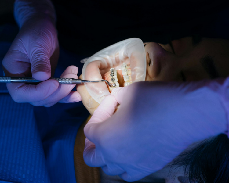 A dental professional wearing gloves uses a tool on a patient wearing a cheek retractor during an orthodontic procedure.