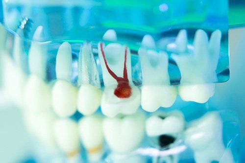 A close up of a model of a tooth with a hole in it.
