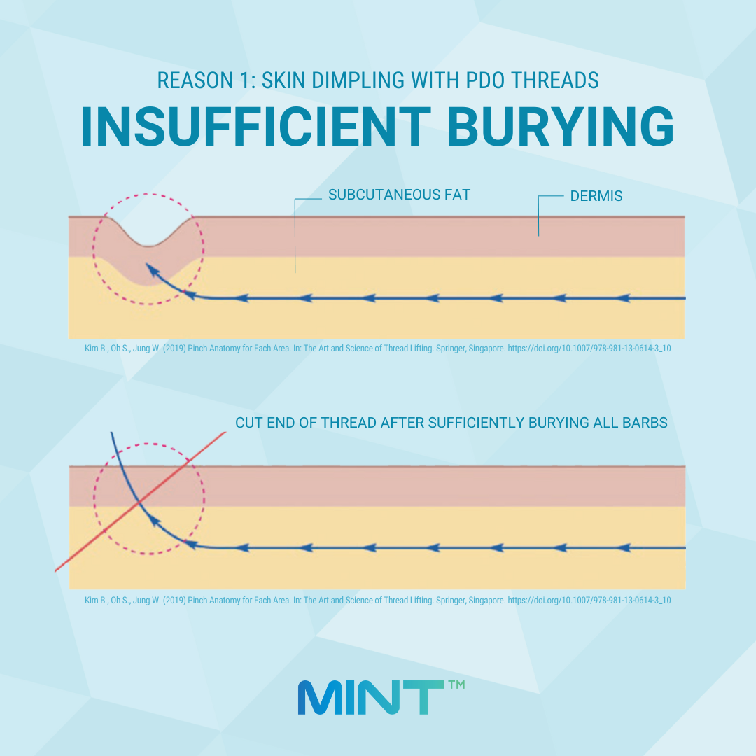 PDO Thread Skin Dimpling from Insufficient Burying