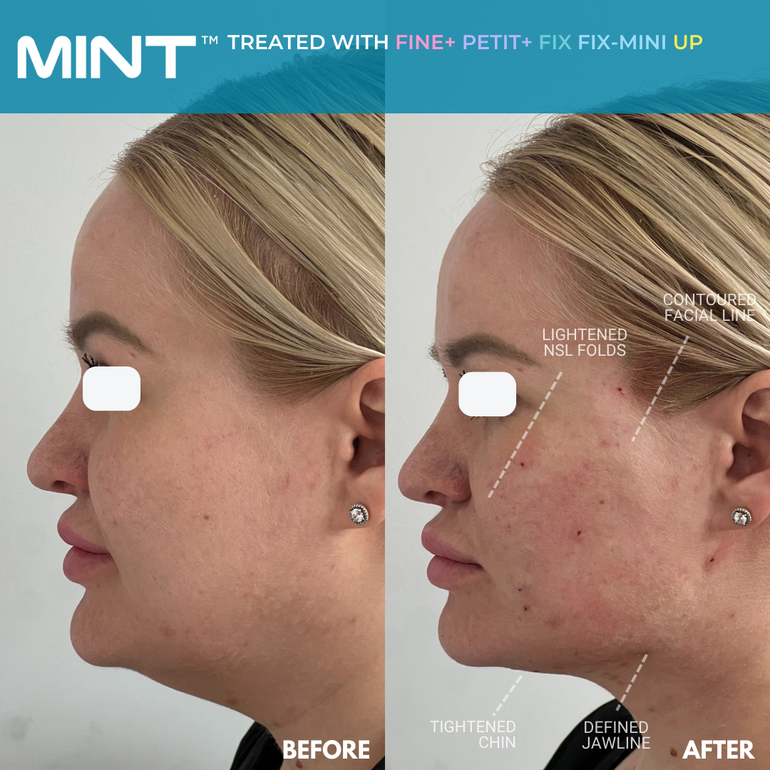 PDO Thread Lift Complications and Minimizing Risks