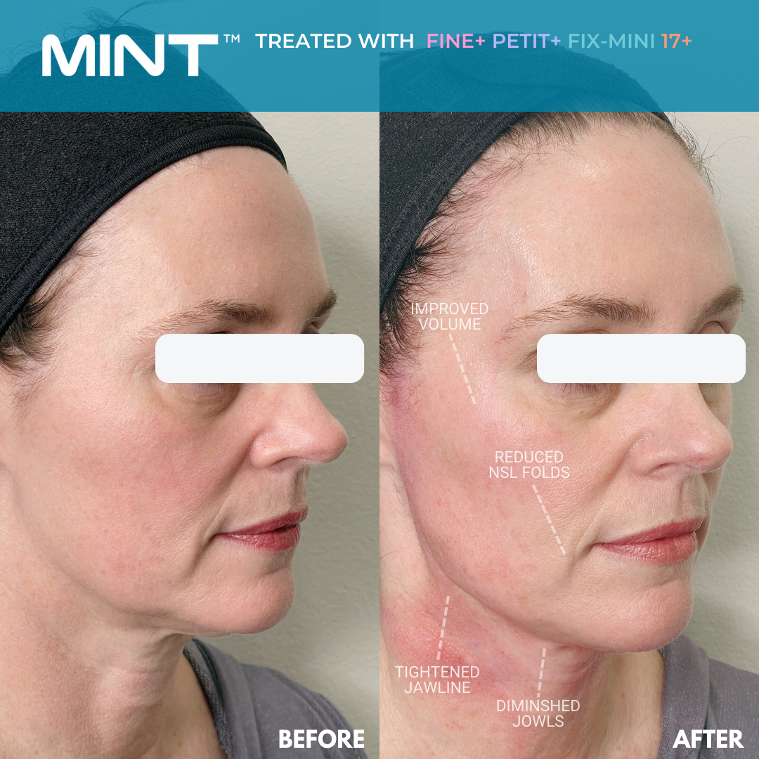 thread lift before and after of middle age woman