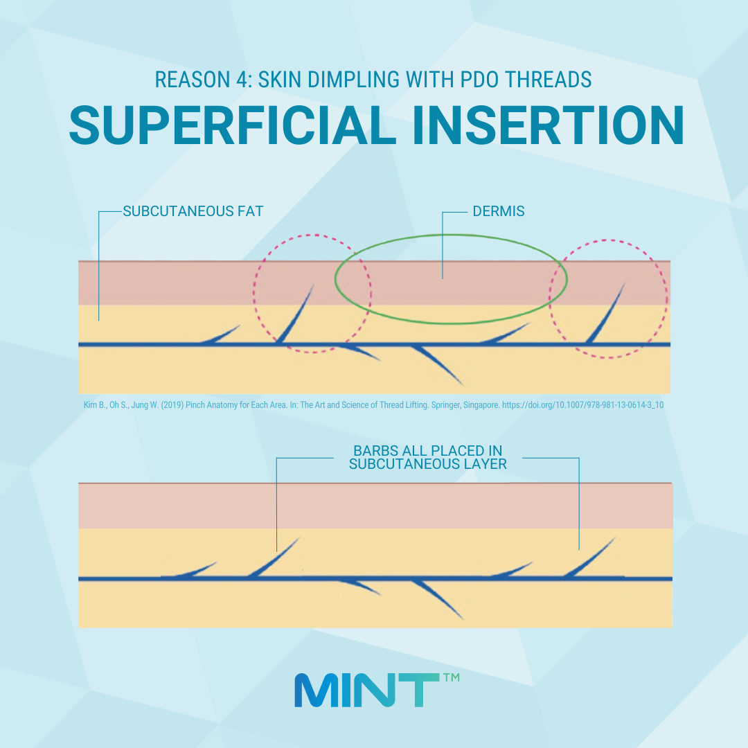 PDO Thread Skin Dimpling from Superficial Insertion