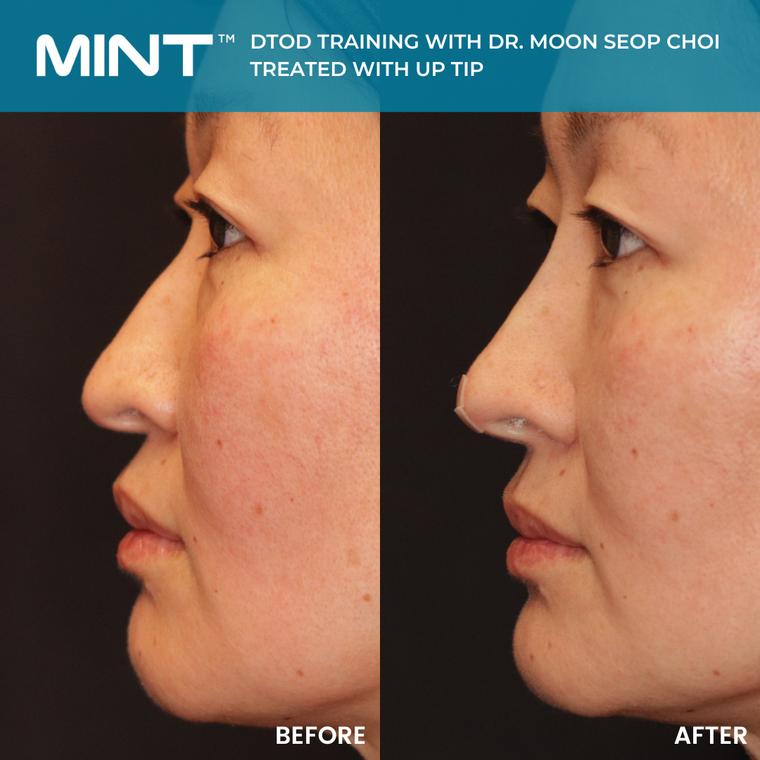 PDO thread lift before and after for nose