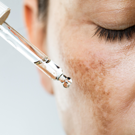 Skin booster applied topically to treat melasma