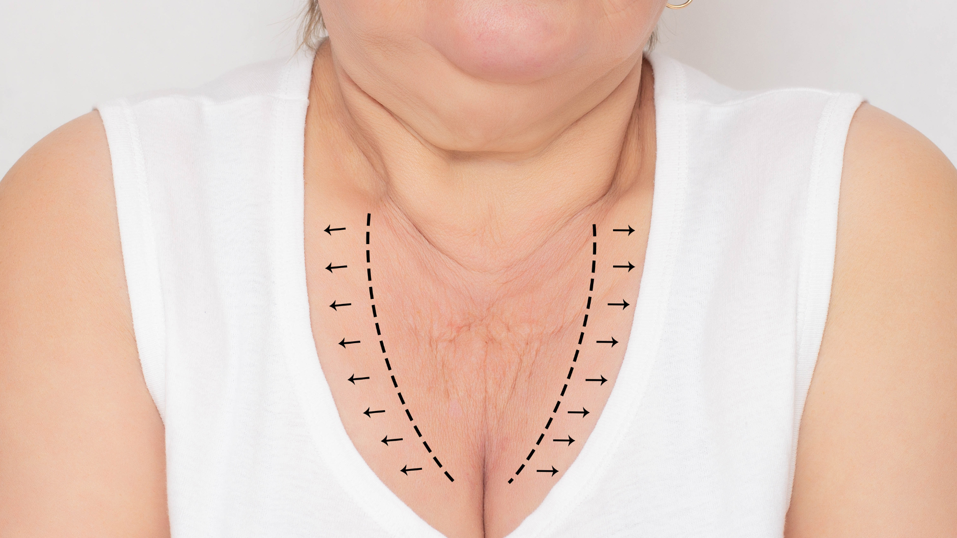 Chest wrinkles on woman about to have PDO thread lift
