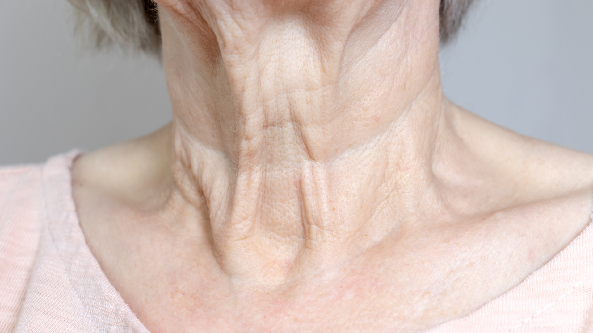 Woman with sagging neck preparing for PDO threads