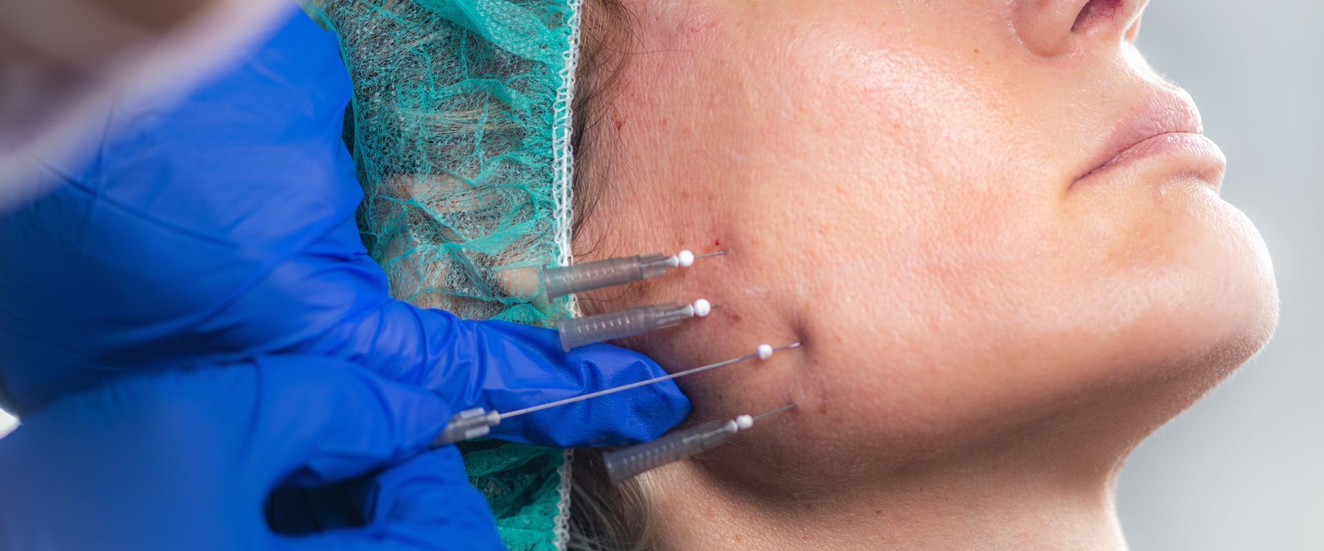 Smooth and barbed pdo threads to address skin sagging