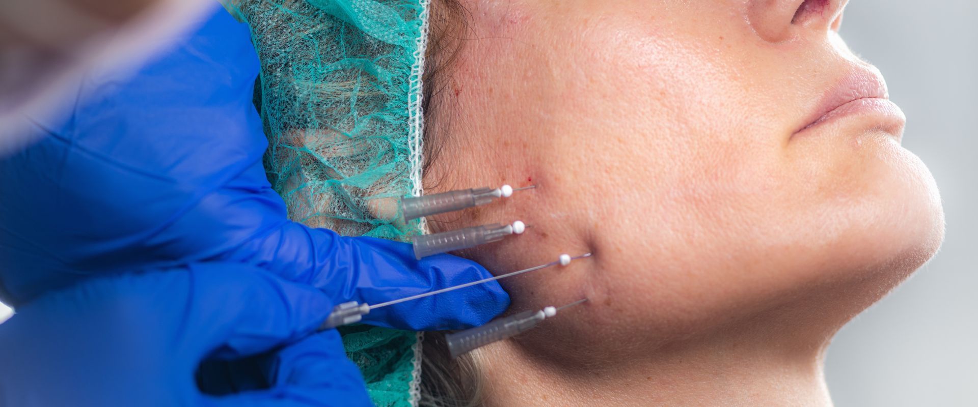 PDO Thread Lift for Non-surgical Skin Tightening