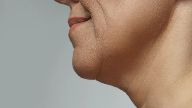 Profile of a woman showing a double chin before thread lift treatment.