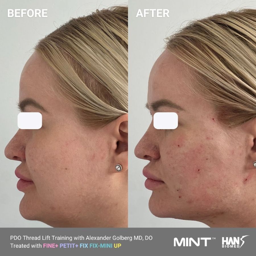 PDO Thread Lift for Jawline: Before & After Photo (No Vector Lines)