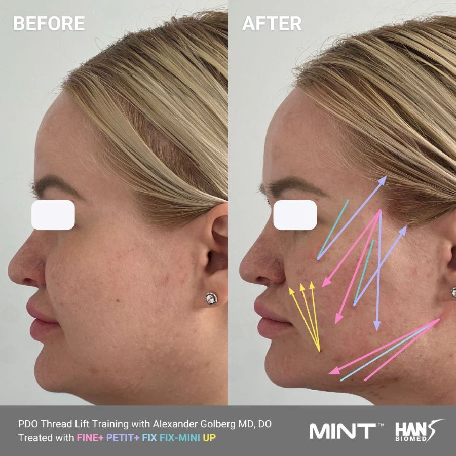 PDO Thread Lift for Jawline: Before & After Photo (With Vector Lines)