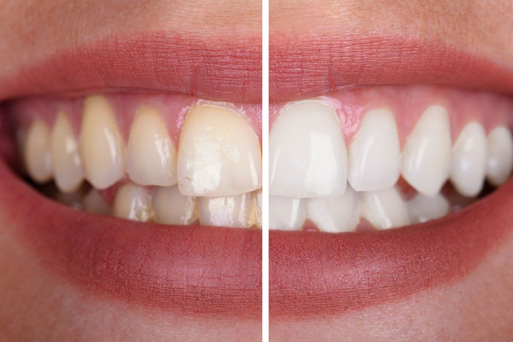 before and after teeth whitening photo
