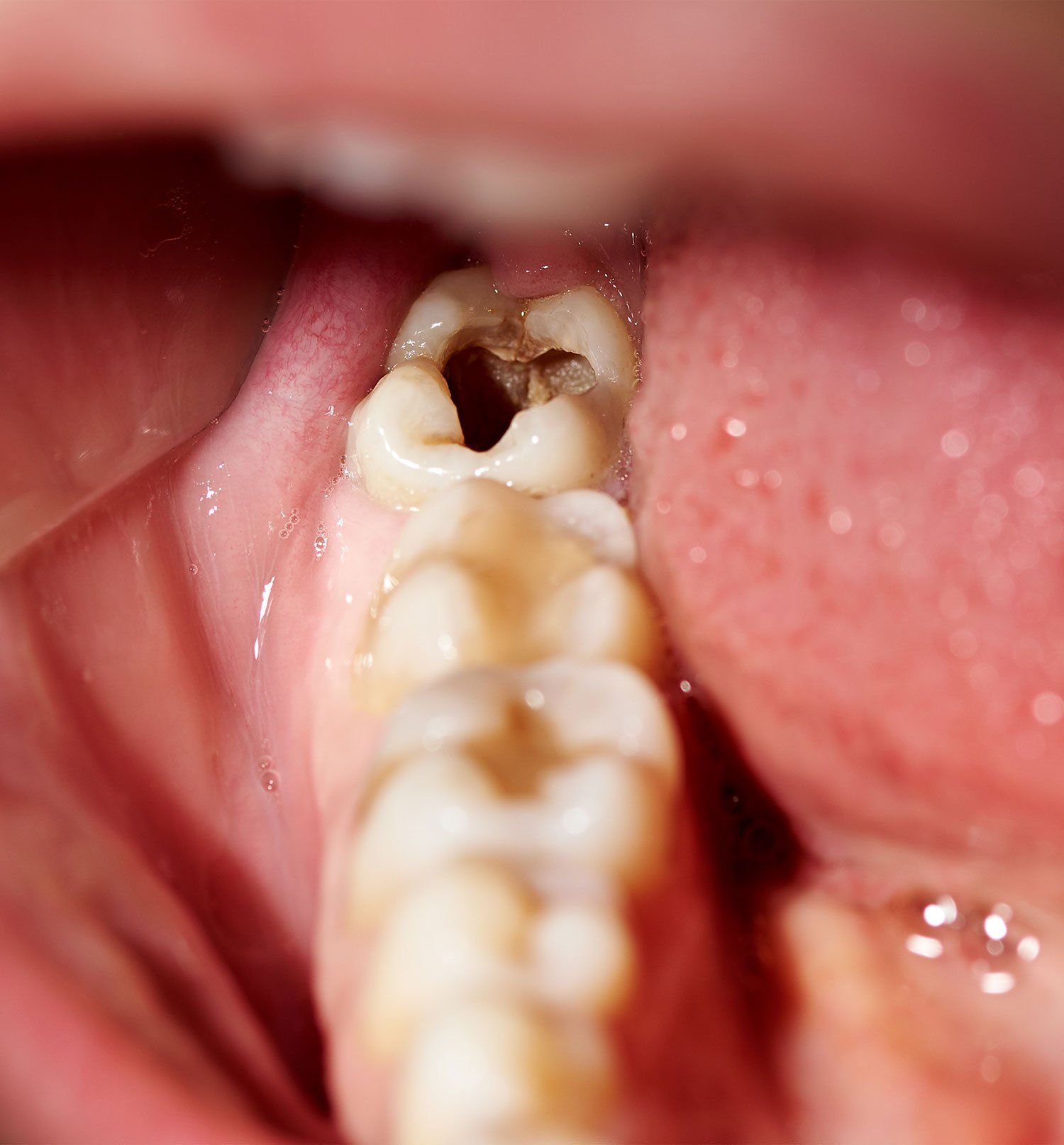 cavity in tooth