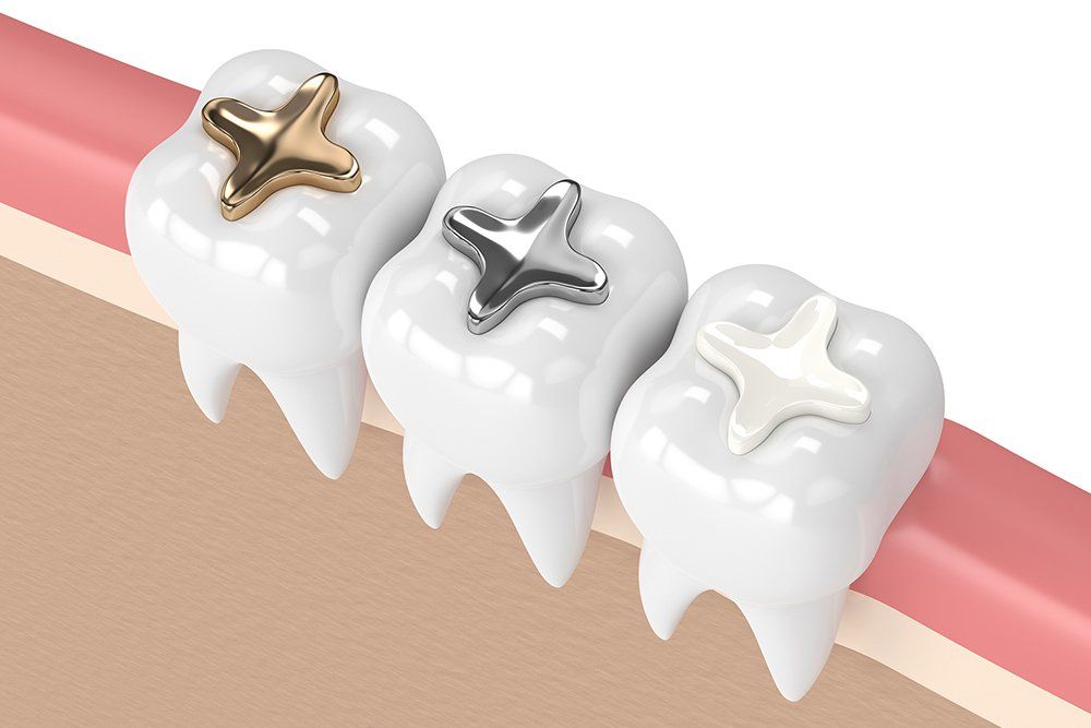 tooth-colored filling options