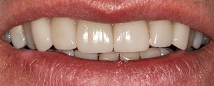 A close up of a person 's mouth with white teeth.