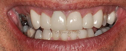A close up of a man 's teeth with white teeth.