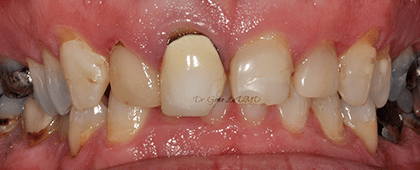 A close up of a person 's teeth with a missing tooth.