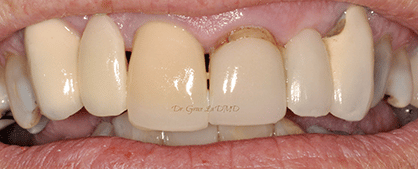 A close up of a person 's teeth with a broken tooth.