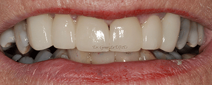 A close up of a person 's teeth with a red lip.