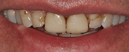 A close up of a person 's teeth with a smile on their face.