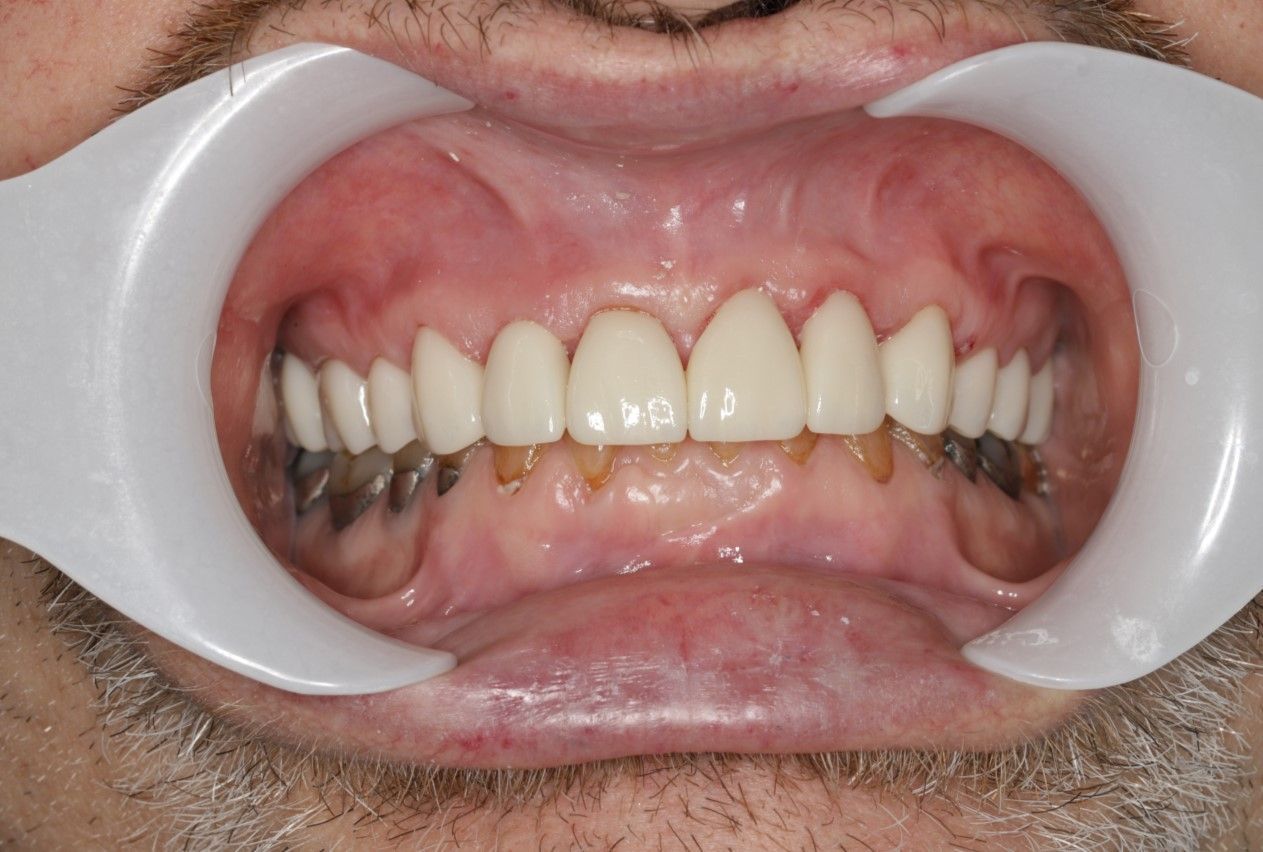 A close up of a man 's mouth with braces on his teeth.