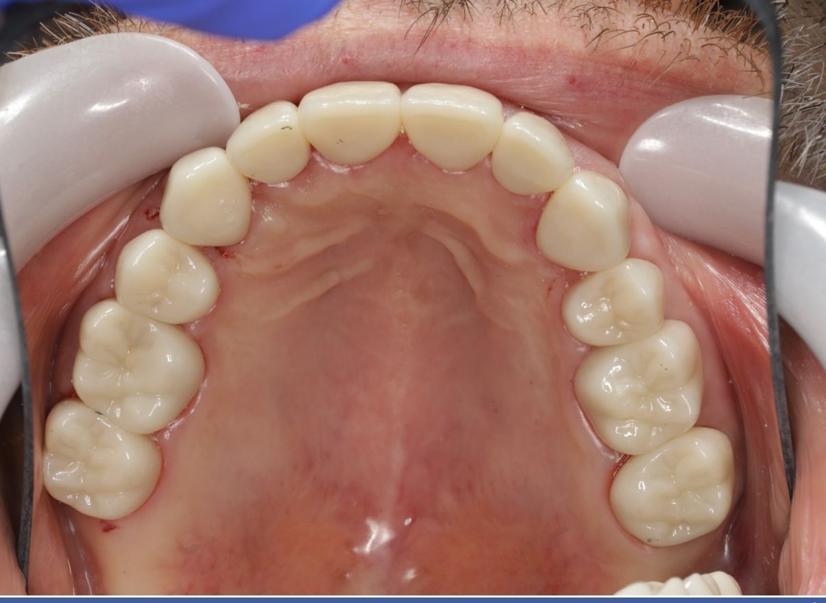 A close up of a person 's teeth with dental gloves on.