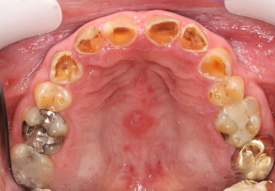 A close up of a person 's teeth with a lot of holes in them.