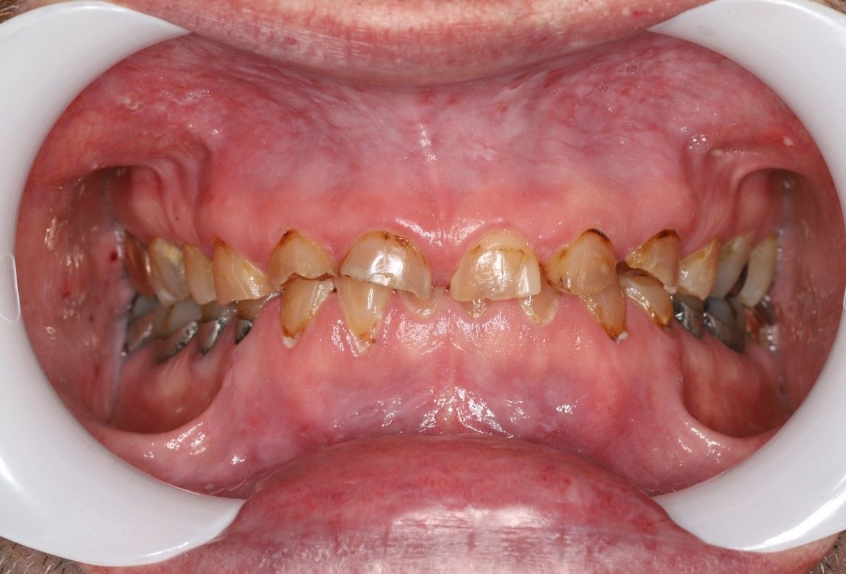 A close up of a person 's mouth with a white ring around it.