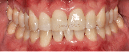 A close up of a person 's teeth and gums.