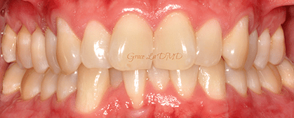 A close up of a person 's teeth with a red gums.