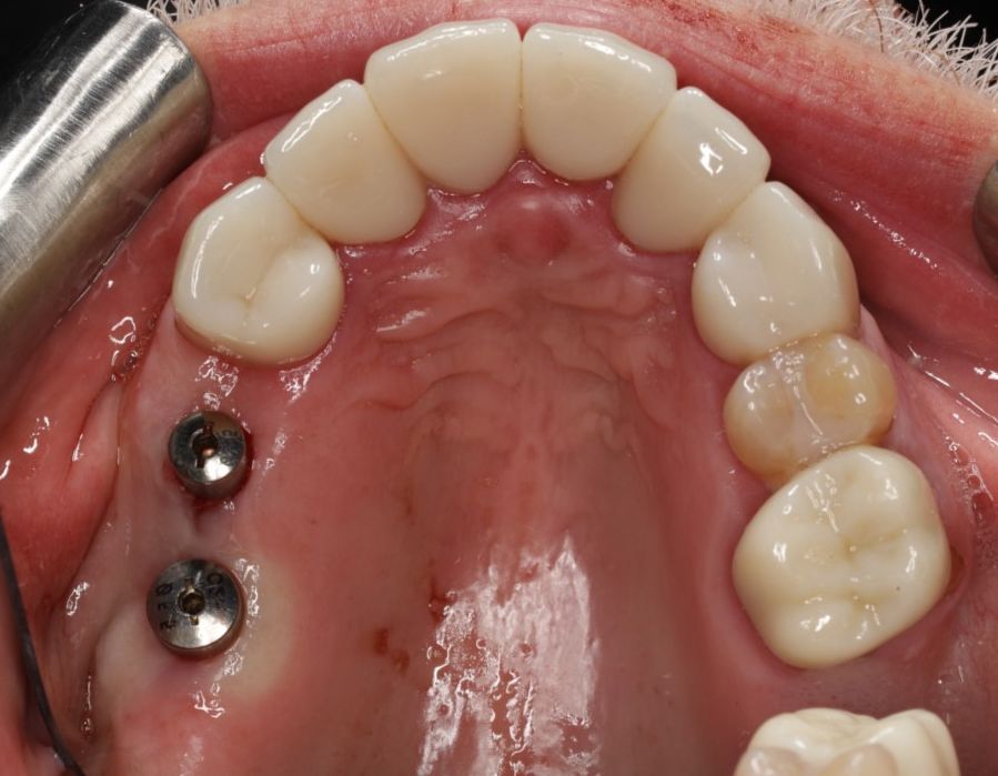A close up of a person 's teeth with dental implants.