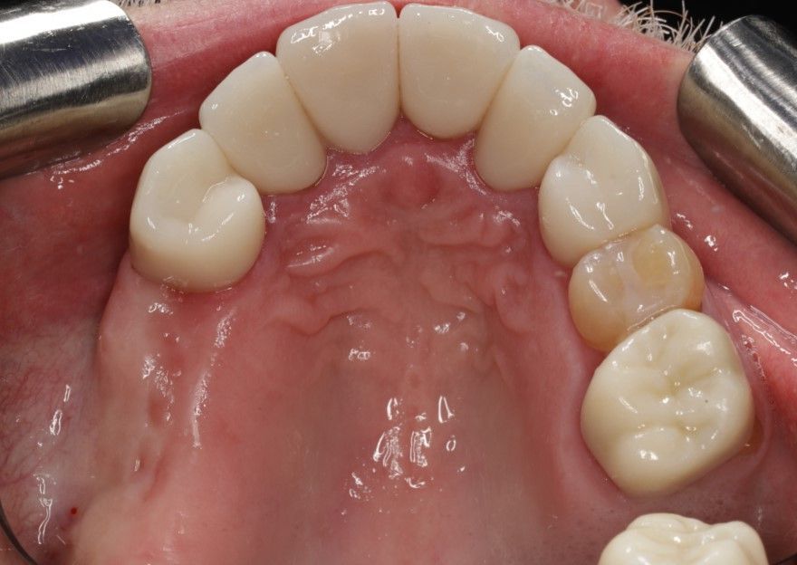 A close up of a person 's mouth with a lot of teeth.