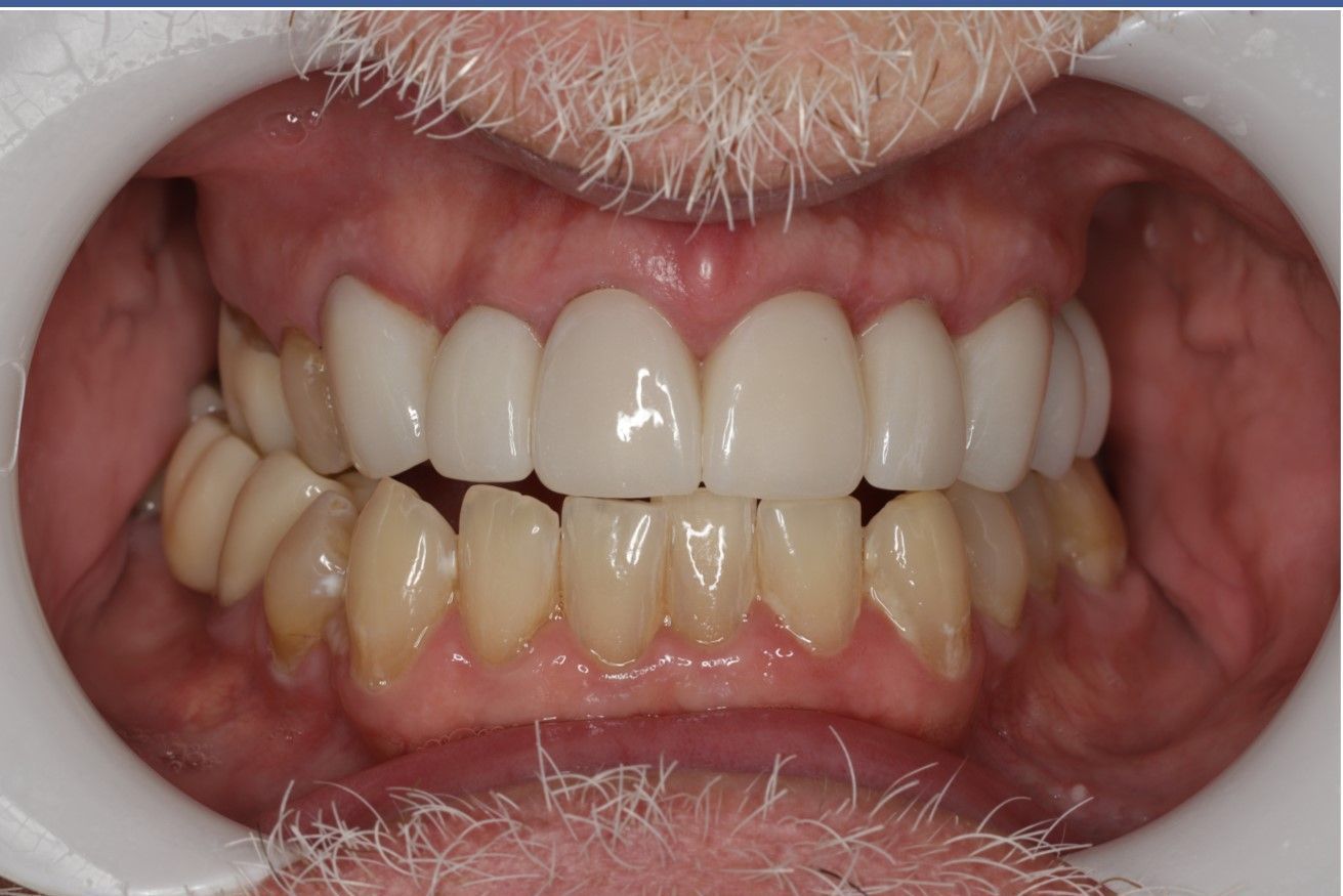 A close up of a man 's teeth with a beard.