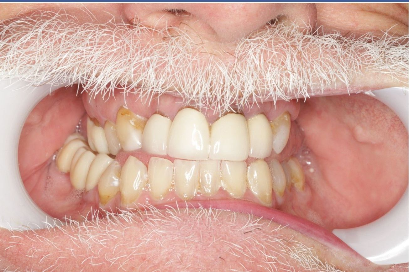 A close up of a man 's mouth with a beard and white teeth.