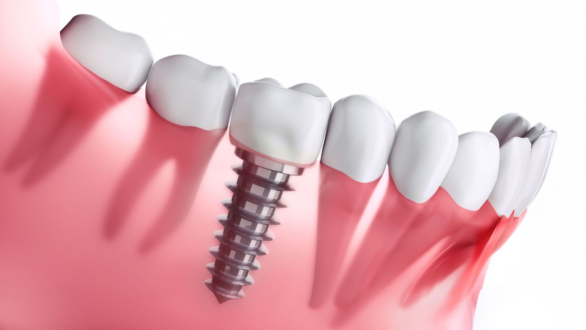 Diagram of mouth with dental implant