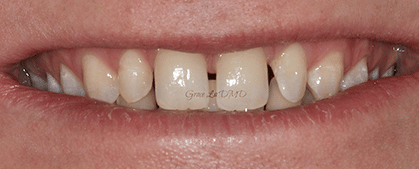 A close up of a person 's mouth with white teeth.