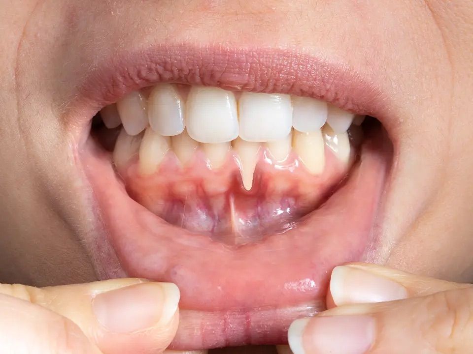 Close-up view of open mouth, revealing teeth and gums. Fingers pull lower lip down.