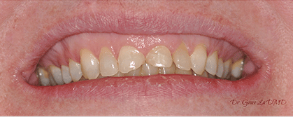 A close up of a person 's mouth showing their teeth.