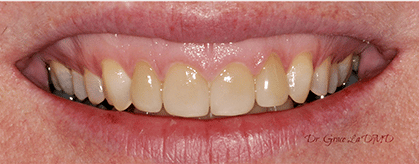 A close up of a person 's mouth with white teeth.