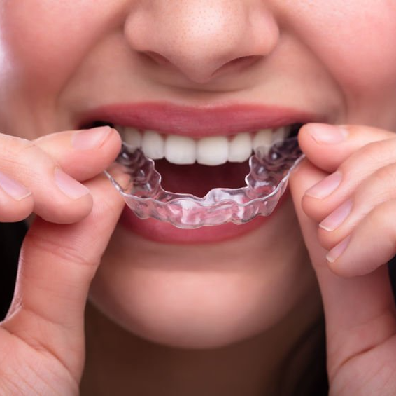 Woman inserting clear aligners like Invisalign