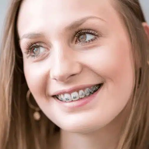 Woman smiling showing her braces in Pepper Pike, Ohio