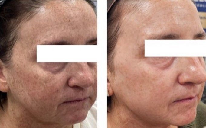 Intense Pulsed Light (IPL) Photofacial