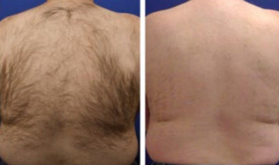 Laser Hair Removal