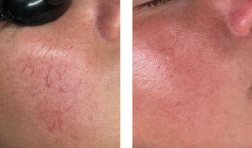 Spider Vein Removal