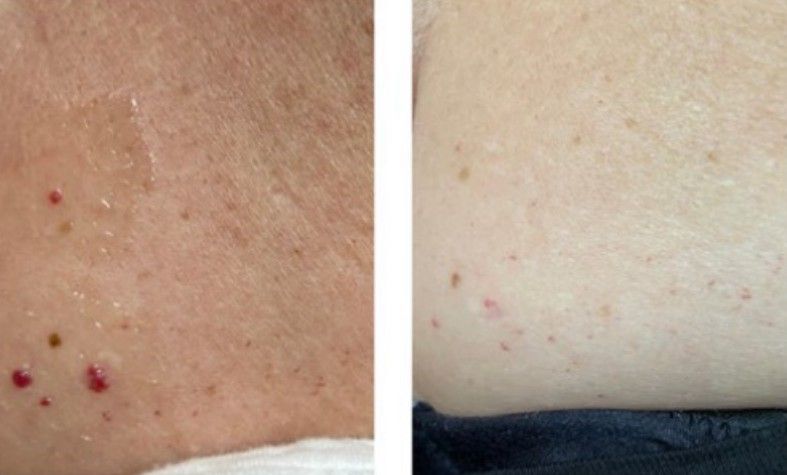 Skin with red and brown spots, before and after treatment.