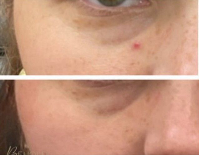 Before and after comparison of a face, showing a red spot removed from under the eye. Skin tone is fair.
