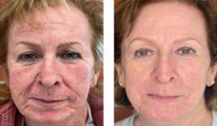 Side-by-side comparison of a woman's face, before and after cosmetic work. Reduction in wrinkles and improved skin tone.