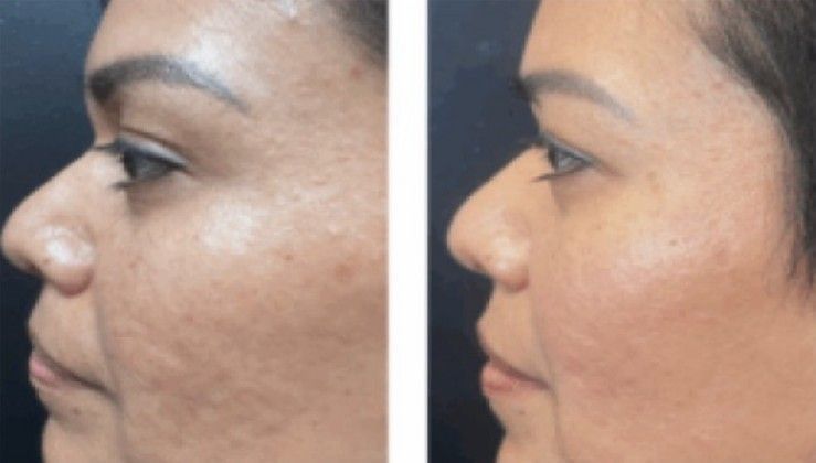 Side-by-side comparison of a woman's profile before and after a facial treatment, showing reduced scarring and improved skin tone.