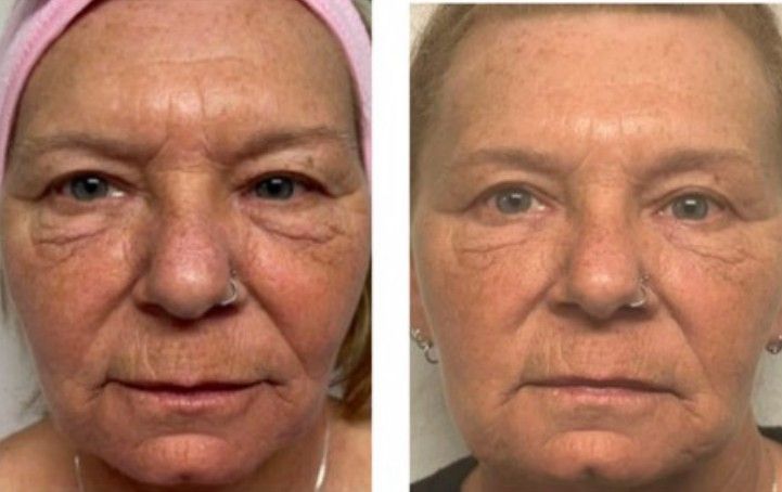 PiXel8 RF Microneedling