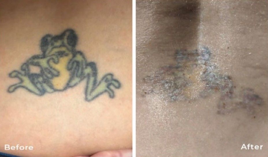 Tattoo Removal